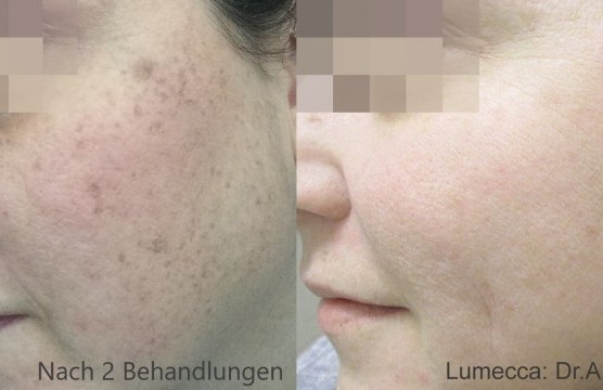 Fotos von Behandlungsforschritten einer Beautybehandlung im Gesicht.